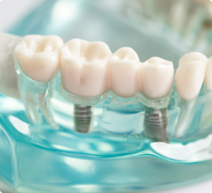 ¡Recupera tu sonrisa con nuestros implantes dentales en Sabadell!